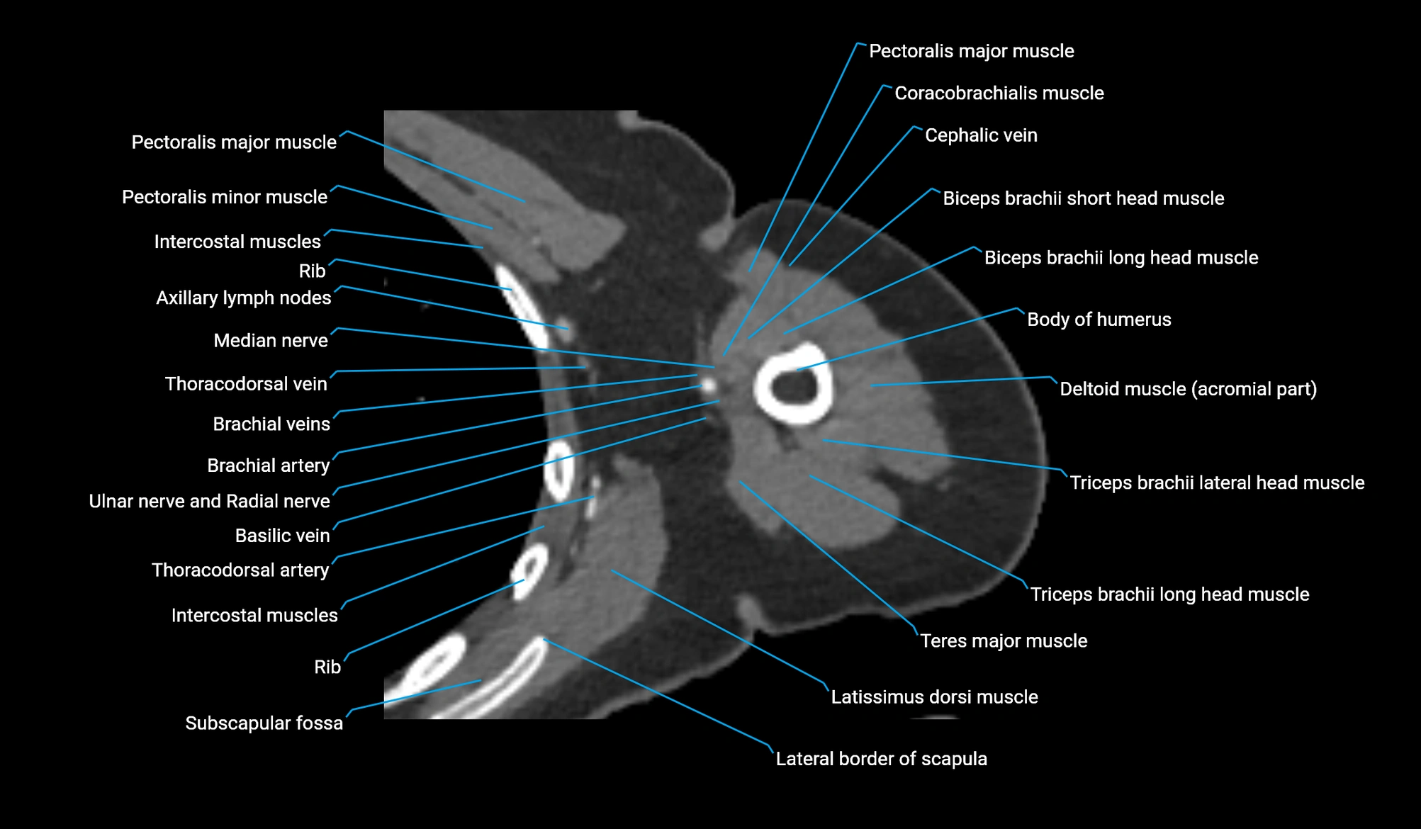 CT upper arm axial  cross sectional anatomy labelled radiology image -00164.webp